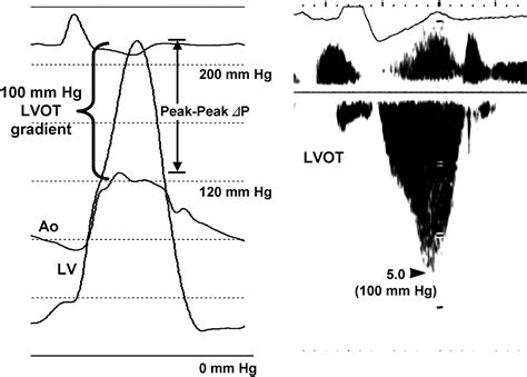 lv gradient|lvot gradient chart.